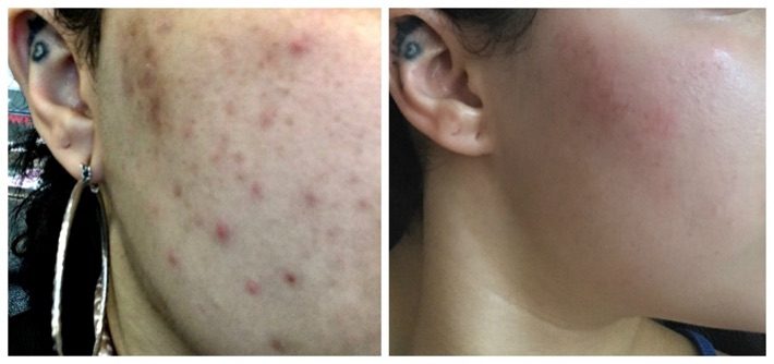 Before and after Acne Treatment results at Viore Laser Skincare MedSpa, example 1