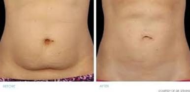 Before and after CoolSculpting Fat Reduction results at Viore Laser Skincare MedSpa, example 1