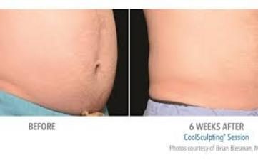 Before and after CoolSculpting Fat Reduction results at Viore Laser Skincare MedSpa, example 4