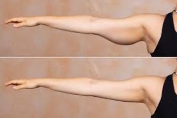 Before and after CoolSculpting Fat Reduction results at Viore Laser Skincare MedSpa, example 5