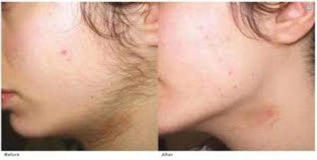 Before and after Laser Hair Removal results at Viore Laser Skincare MedSpa, example 4