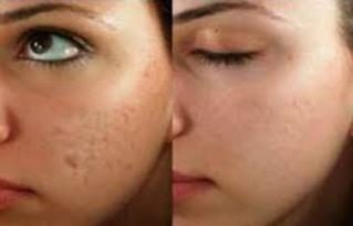 Before and after Microneedling results at Viore Laser Skincare MedSpa, example 1