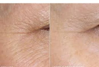 Before and after Microneedling results at Viore Laser Skincare MedSpa, example 2