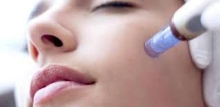Before and after Microneedling results at Viore Laser Skincare MedSpa, example 5