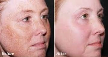 Before and after IPL & BBL Photo Facial results at Viore Laser Skincare MedSpa, example 1