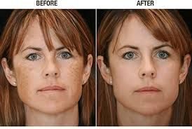 Before and after IPL & BBL Photo Facial results at Viore Laser Skincare MedSpa, example 3