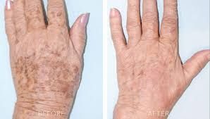 Before and after IPL & BBL Photo Facial results at Viore Laser Skincare MedSpa, example 5