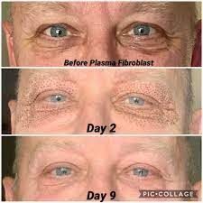 Before and after Plasma Fibroblast Skin Tightening results at Viore Laser Skincare MedSpa, example 2