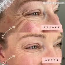 Before and after Plasma Fibroblast Skin Tightening results at Viore Laser Skincare MedSpa, example 3