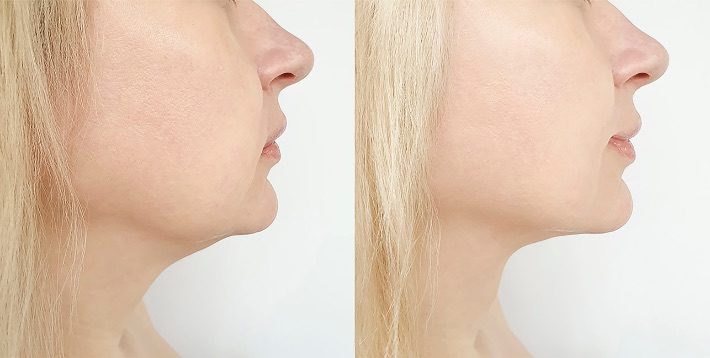 Before and after Radio Frequency Microneedling results at Viore Laser Skincare MedSpa, example 2