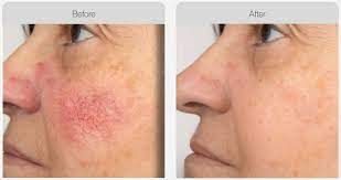 Before and after Spider Vein Treatment results at Viore Laser Skincare MedSpa, example 1