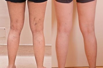 Before and after Spider Vein Treatment results at Viore Laser Skincare MedSpa, example 3